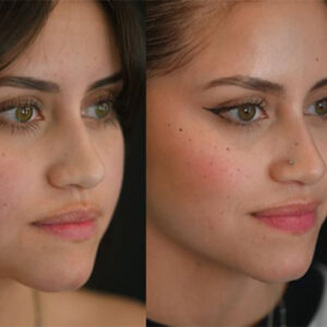 جراحی تغییر شکل چانه