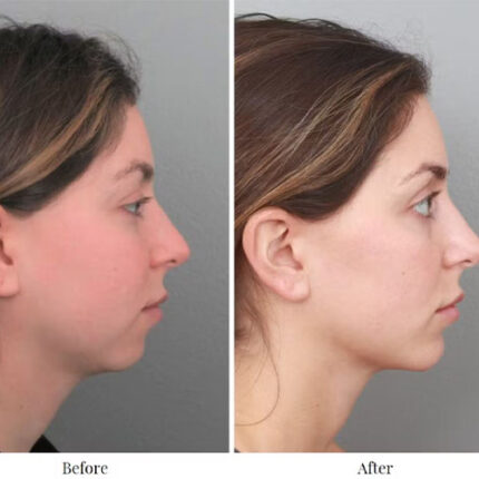 جراحی تغییر شکل چانه