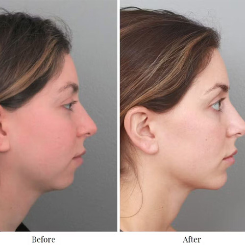 جراحی تغییر شکل چانه