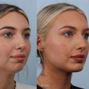 جراحی تغییر شکل چانه