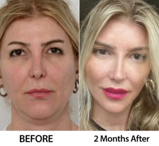 لیفت گونه با آندوسکوپ