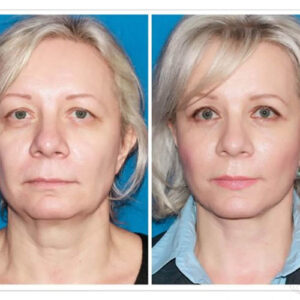 لیفت صورت اندوسکوپی