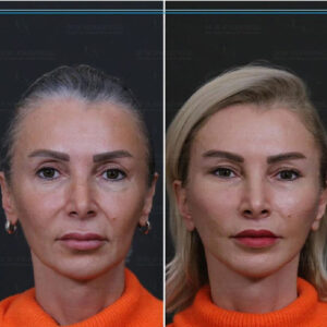 لیفت صورت اندوسکوپی