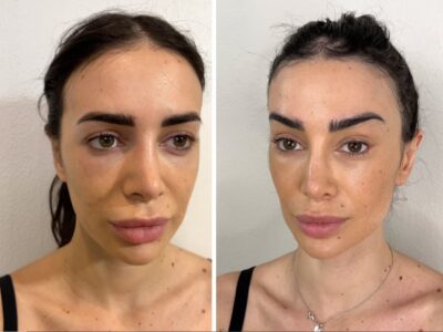 لیفت گونه با آندوسکوپ