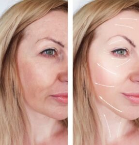 لیفت گونه با آندوسکوپ