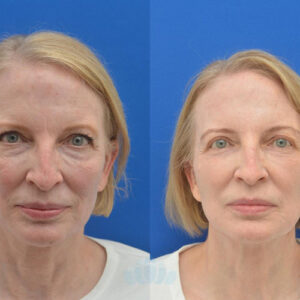 بلفاروپلاستی(پلک بالا و پایین)