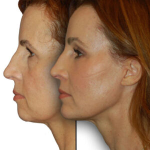 بلفاروپلاستی(پلک بالا و پایین)