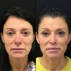 بلفاروپلاستی(پلک بالا و پایین)