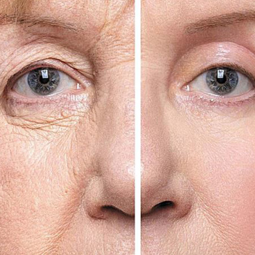 بلفاروپلاستی(پلک بالا و پایین)