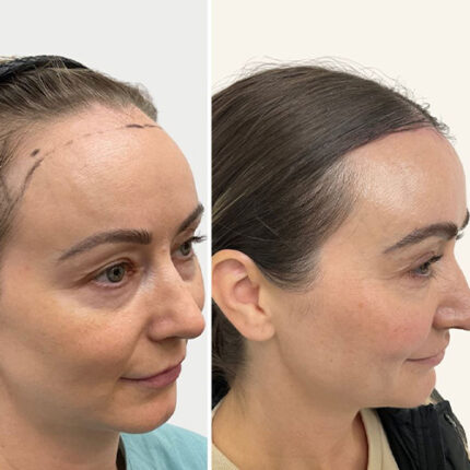 کوتاه کردن پیشانی