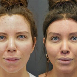 کوتاه کردن پیشانی