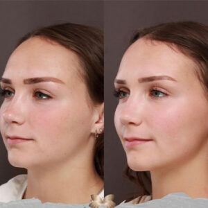 کوتاه کردن پیشانی