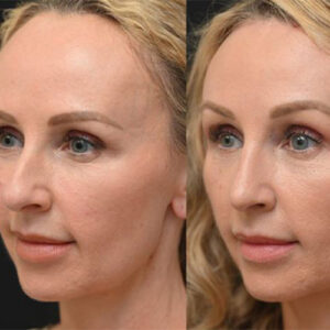 کوتاه کردن پیشانی