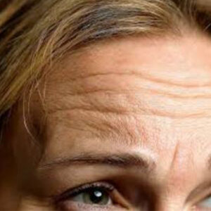 لیفت پیشانی