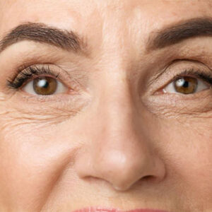 لیفت پیشانی و ابرو