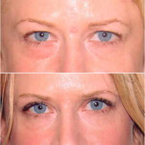 لیفت پیشانی و ابرو