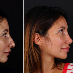 نوزونت بینی