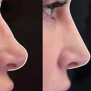 نوزونت بینی