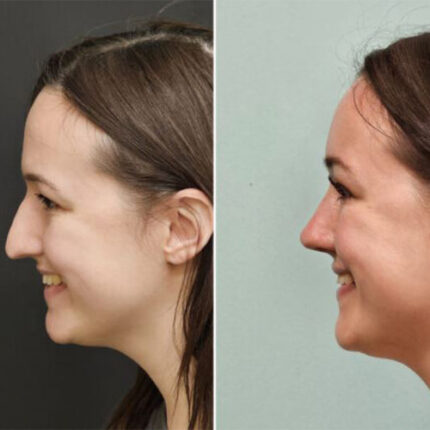 نوزونت بینی