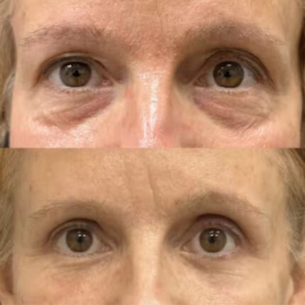 برداشتن چربی زیر چشم