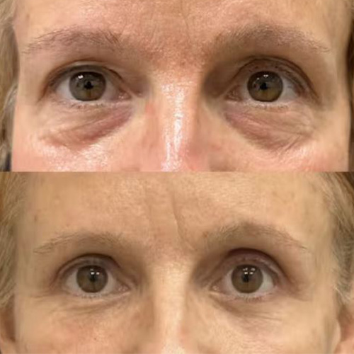 برداشتن چربی زیر چشم