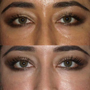 برداشتن چربی زیر چشم