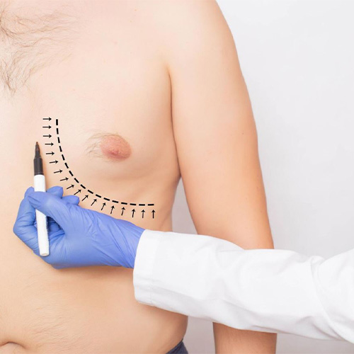 جراحی ژنیکوماستی-عمل های زیبایی در ایران جراحی ژنیکوماستی