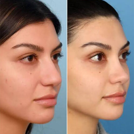 اصلاح جراحی های قبل بینی