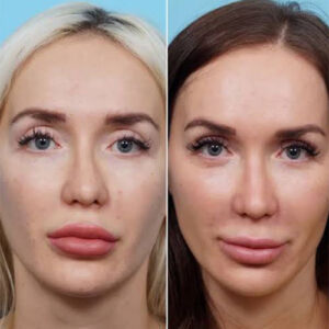 اصلاح جراحی های قبل بینی