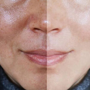 مزایای هیدروفیشیال صورت